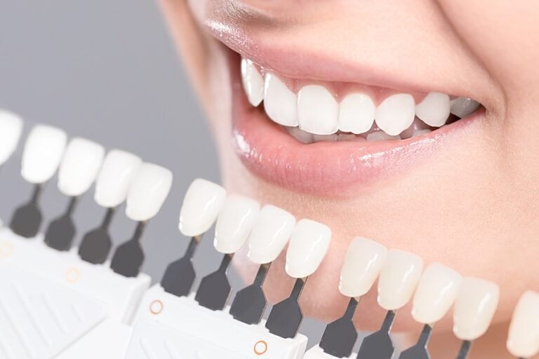 Полезен преглед за Винири Snap-On Smile
