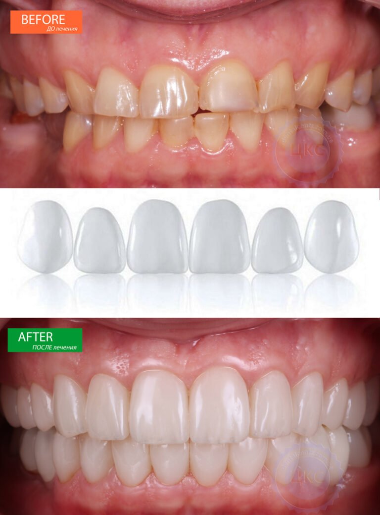 Полезен преглед за Luske Snap-On Smile Slovenia
