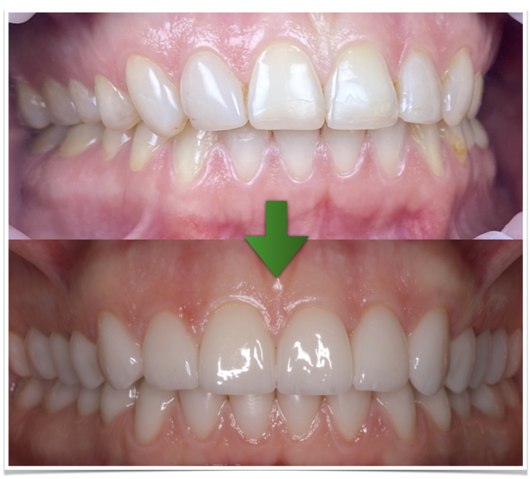 Полезен преглед за Luske Snap-On Smile Slovenia